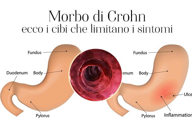 Morbo di Crohn: i cibi che possono limitare i sintomi