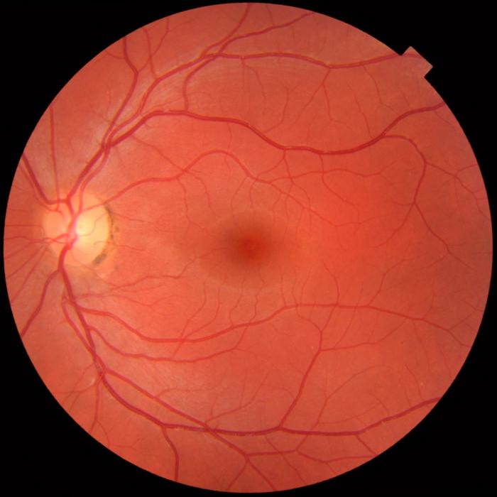 Malattie degenerative della retina: cosa si può fare?