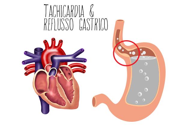 Tachicardia e reflusso gastrico