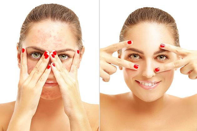 Le differenze tra acne lieve, moderata o grave