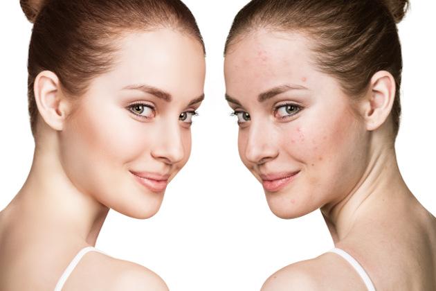 L'acne: cos'è e come si cura