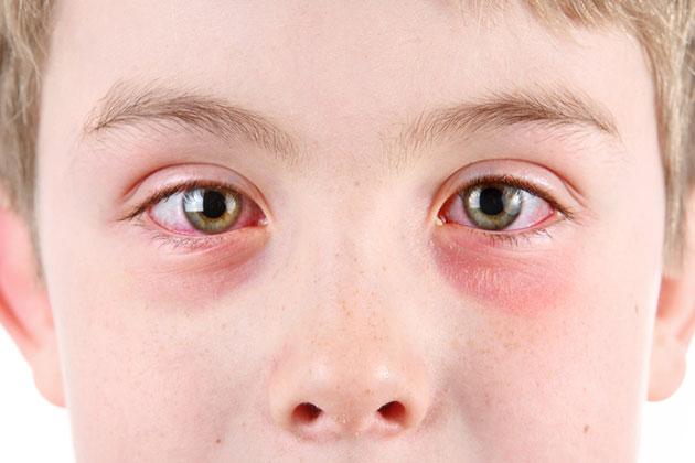Occhi e allergia al sole: le prospettive di cura