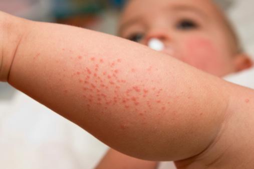 Il PO-SCORAD: un valido aiuto nella valutazione della dermatite atopica
