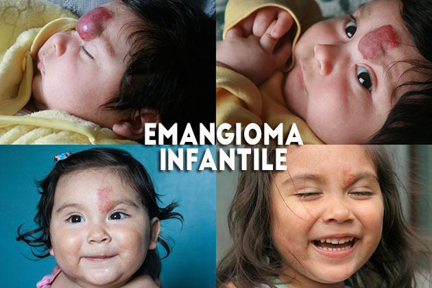 Emangiomi infantili: quelle lesioni rosse della pelle