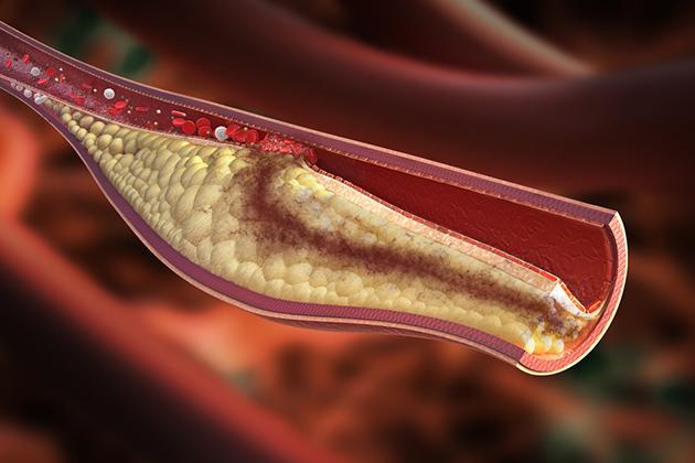Esami del sangue: focus su colesterolo e trigliceridi