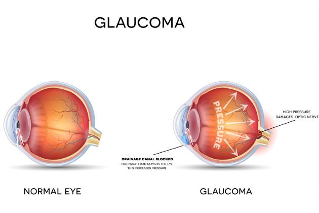 Glaucoma: come tenerlo sotto controllo