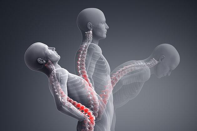 Spondilite anchilosante: un mal di schiena che non passa