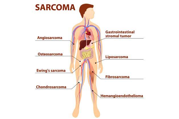Sarcomi: i tumori dei tessuti molli
