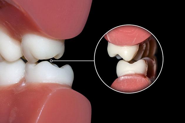 I rischi connessi con il digrignare i denti