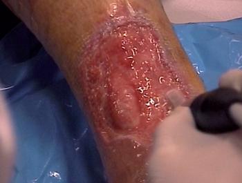 Low-Frequency Ultrasonic Debridement and Collagenic Therapy in the management of chronic leg ulcers with a new integrated method