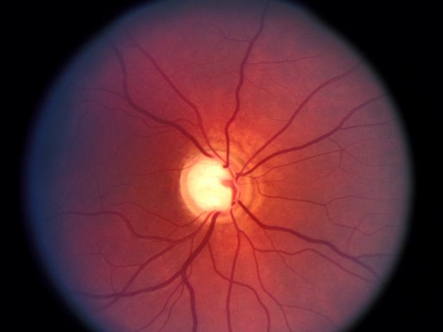 Il glaucoma: dubbi e contraddizioni