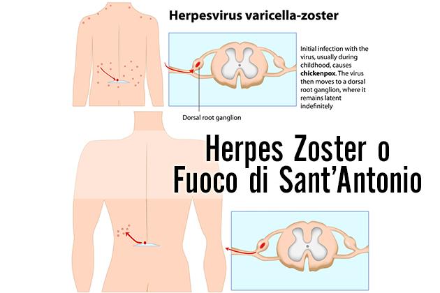 L'Herpes Zoster o Fuoco di Sant'Antonio