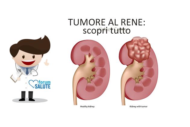 Il tumore del rene