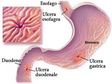 Ulcera: cosa mangiare