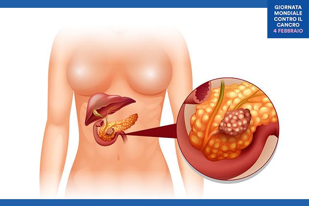 Tumore al pancreas: fondamentale riconoscere i segni premonitori