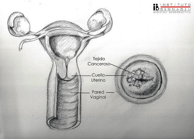 Isterectomia, cos'è e come si fa