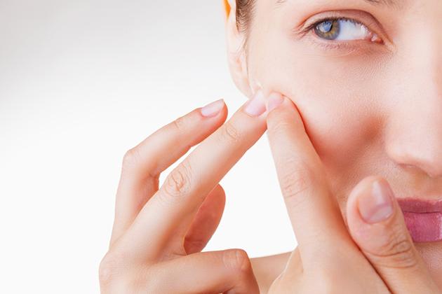 6 errori da non fare con l'acne in inverno