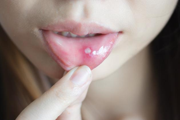 Afte della bocca: sintomi, cause e rimedi