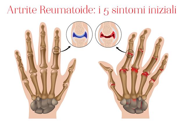 primi sintomi di artrite reumatoide