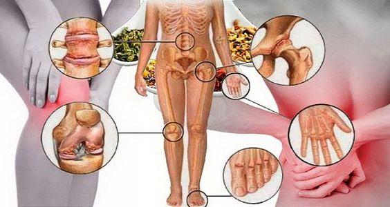 Artrosi diffusa? 10 rimedi naturali al dolore