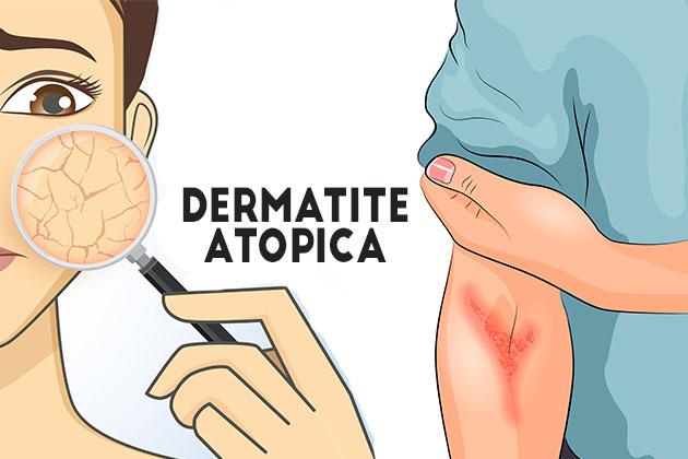 Pelle secca o dermatite atopica?