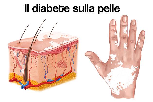 Diabete e malattie della pelle: i 10 disturbi più frequenti