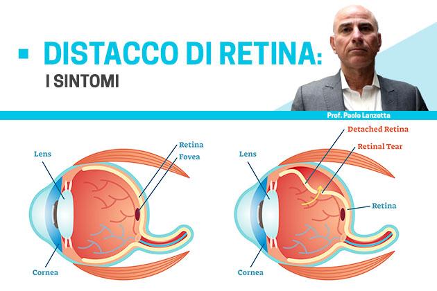 Distacco di retina: sintomi e possibili terapie