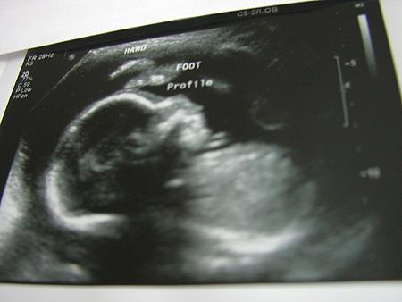 Super amniocentesi, cos'è e come funziona
