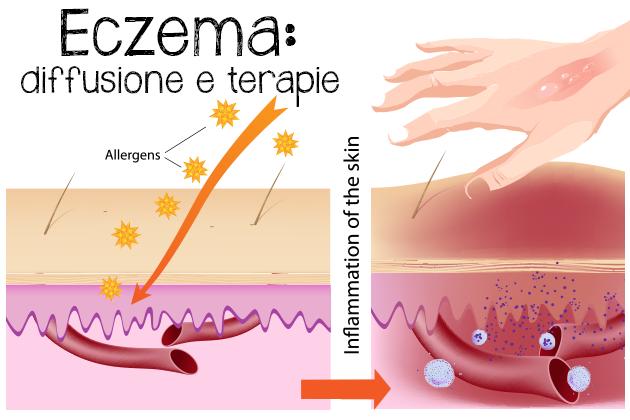 Eczema cronico delle mani