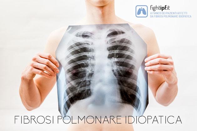 Fibrosi polmonare idiopatica (IPF): cos’è, come si manifesta, come si cura