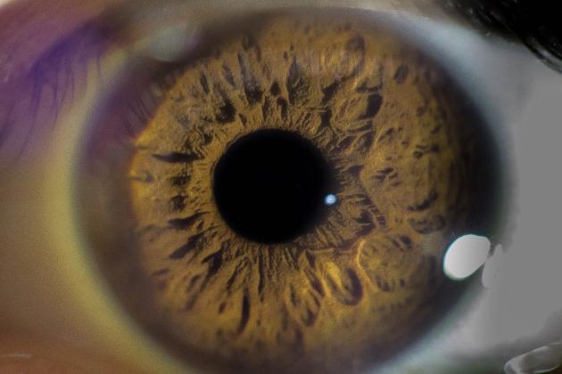 Glaucoma: una malattia silenziosa che spegne i tuoi occhi