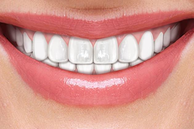 Invisalign: una soluzione per il tuo sorriso o problema di denti