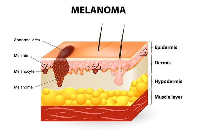 Melanoma, sintomi, cause da evitare e cura possibile