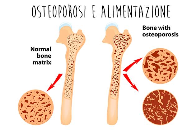 Prevenire l’osteoporosi a tavola