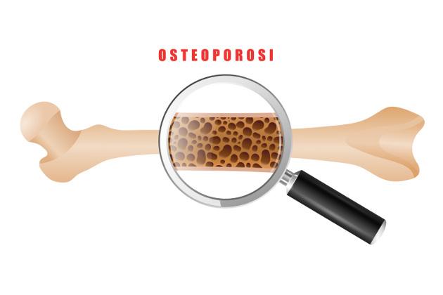 Quante ne sai sull'osteoporosi? Mettiti alla prova