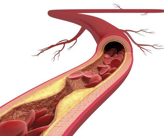 Arterie ostruite: quei 5 sintomi che possono salvarti la vita