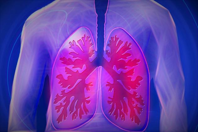 5 cose da sapere sulla polmonite