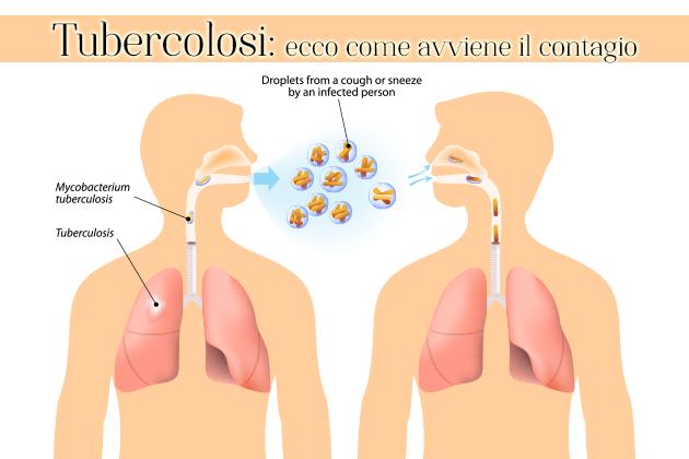 Tubercolosi: una malattia niente affatto scomparsa