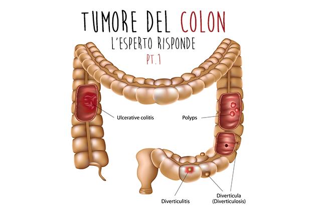 Tumore del colon: l'esperto risponde (prima parte)