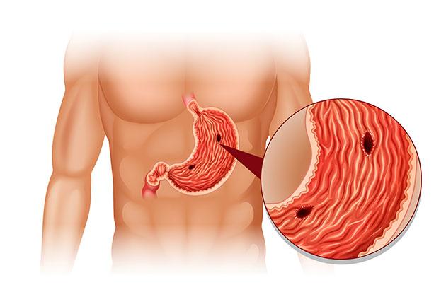 Ulcera: 6 cose da sapere
