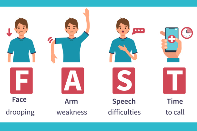 FAST - The symptoms of the mini stroke are the same as those of the typical stroke.