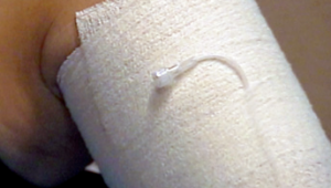 Figure 4. Final dressing with zinc oxide compression bandage; the infusion catheter is exteriorized for topical theraphy carried out at home by the patient