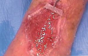 Figure 5. Finalized the growth of granulation tissue, application of GENIX EGI to the edges of the wound to allow the re-epithelialization.