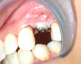 Foto 1: L’impianto è stato appena posizionato in corrispondenza del dente mancante