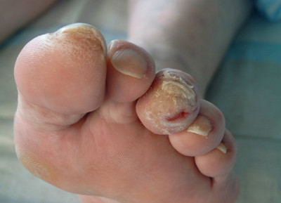 Fig. 1: Lesioni caratteristiche del piede diabetico neuropatico. Ispessimenti della cute e callosità se non adeguatamente trattati possono evolvere nella comparsa di un’ulcera della pelle. L’ulcerazione è una pericolosa porta d’ingresso per i microbi che possono causare una infezione grave dei tessuti delle dita e del piede.